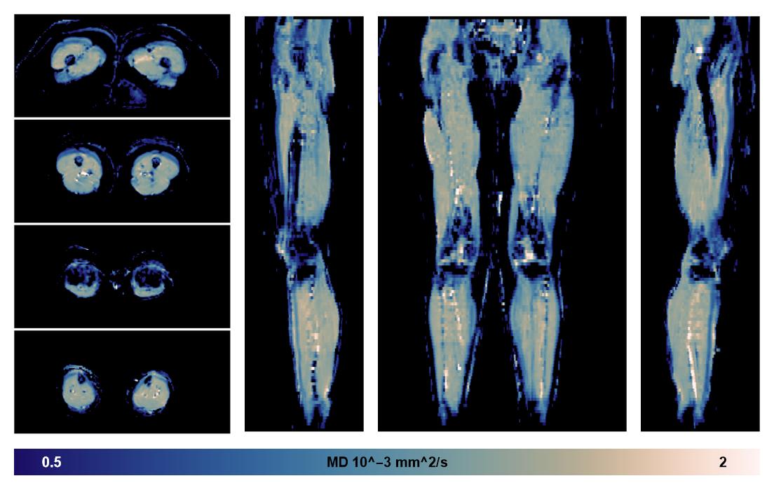 IVIM corrected whole leg muscle mean diffusivity obtained from diffusion tensor imaging.